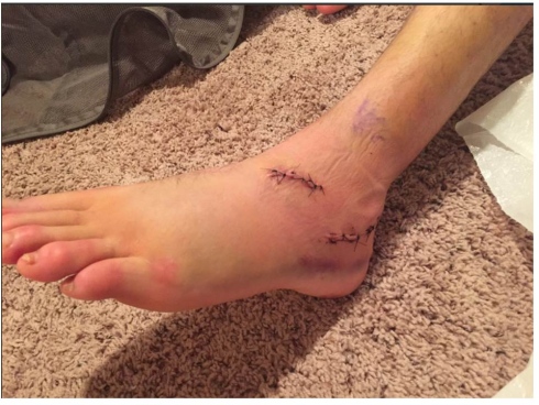 La blessure au pied de Cam Levins